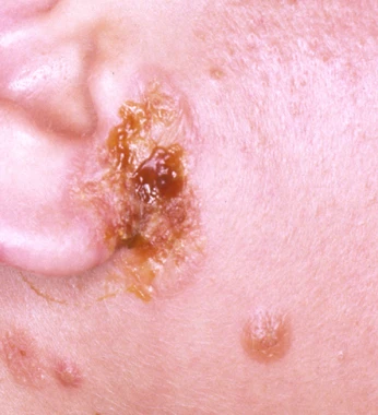 Impetigo